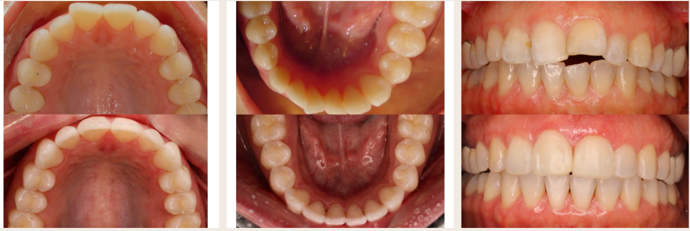 Before and after upper teeth at Smile Studio
