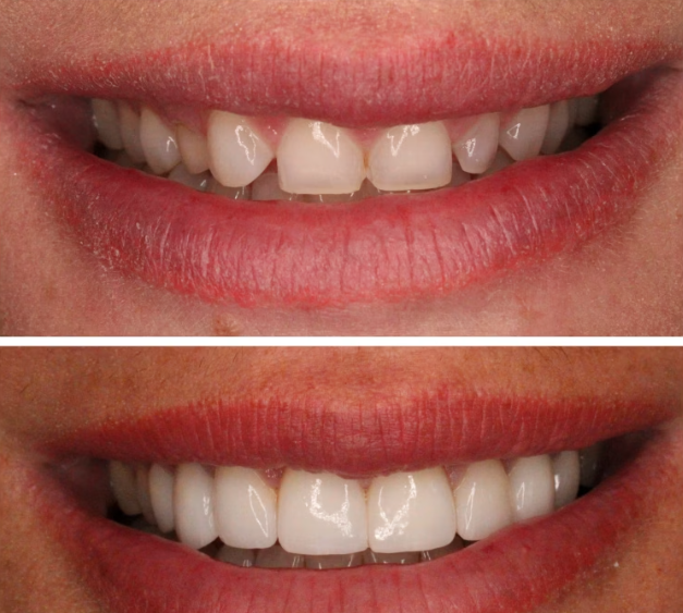 Before and after smile treatment at Smile Studio
