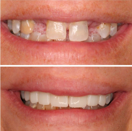 Before and after smile treatment at Smile Studio