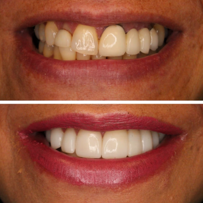 Before and after smile treatment at Smile Studio