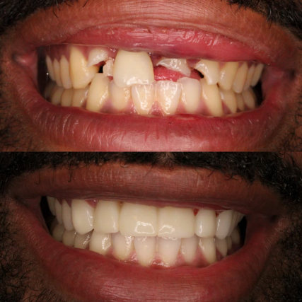 Before and after smile treatment at Smile Studio